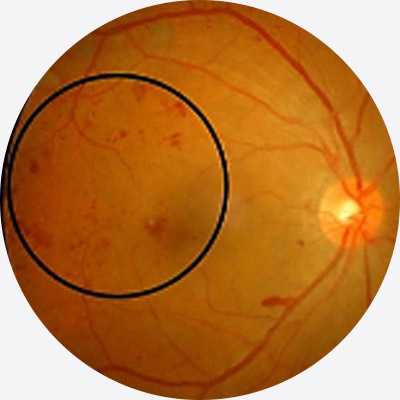 糖尿病引起的視網膜病變，高光譜影像人工智慧辨識系統自動圈選病變區域